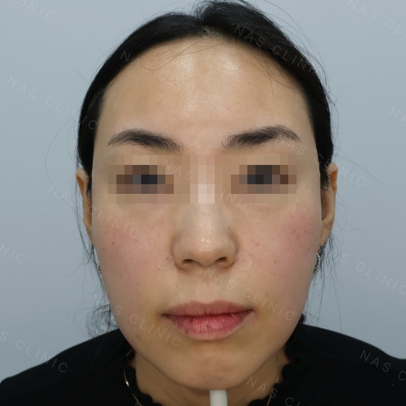 관자·볼 볼륨필러 시술 직후 - 얼굴 정면