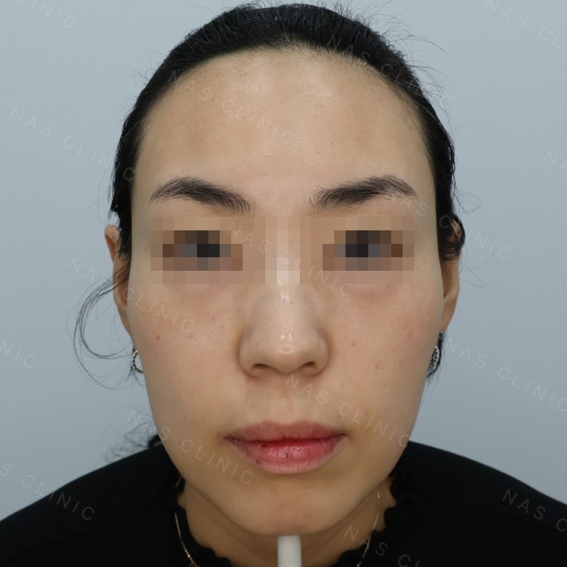 관자·볼 볼륨필러 시술 전 - 얼굴 정면