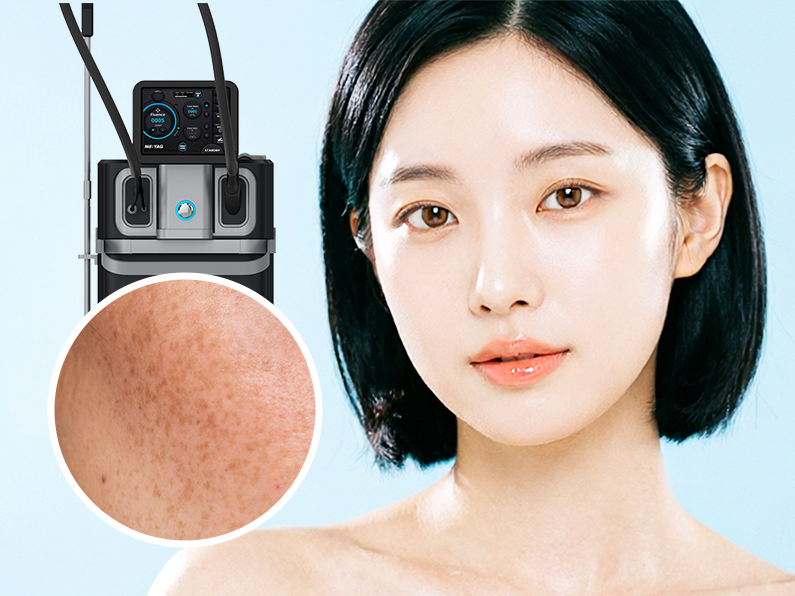 악센토 색소 잡티